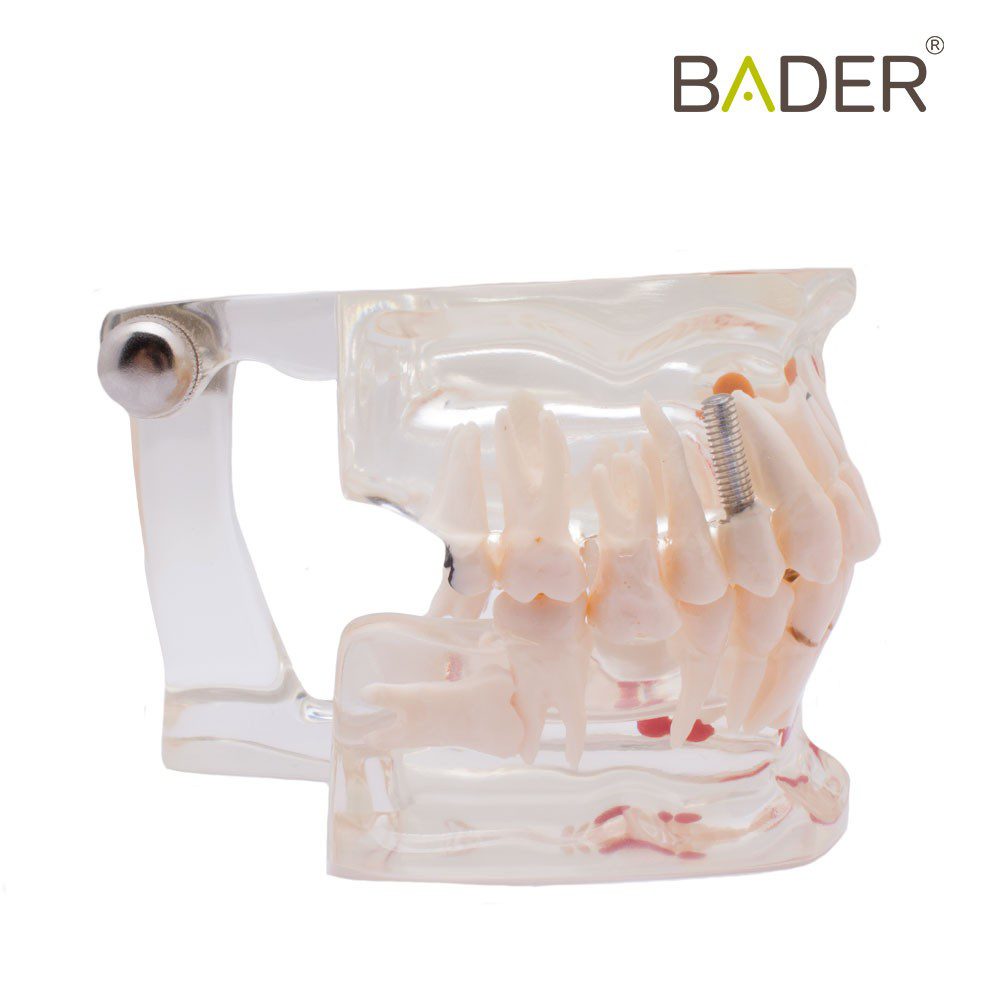 4551-Modello dentale trasparente con impianto.jpg