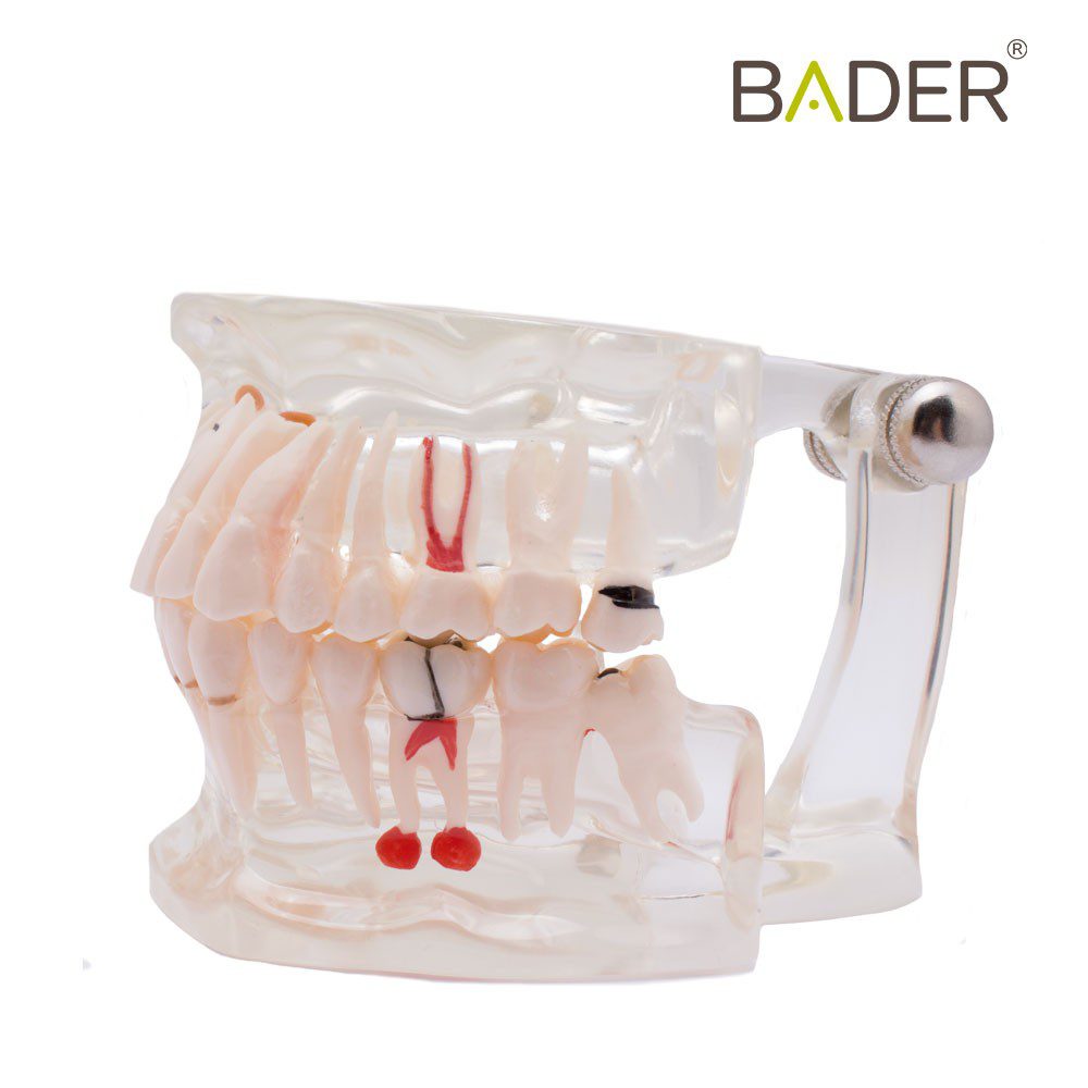 4552-Modello dentale trasparente con impianto.jpg