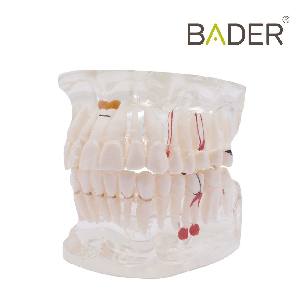 4558-Modello dentale trasparente con impianto.jpg